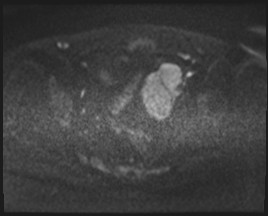 Adnexal multilocular cyst (O-RADS US 3- O-RADS MRI 3) (Radiopaedia 87426-103754 Axial DWI 73).jpg
