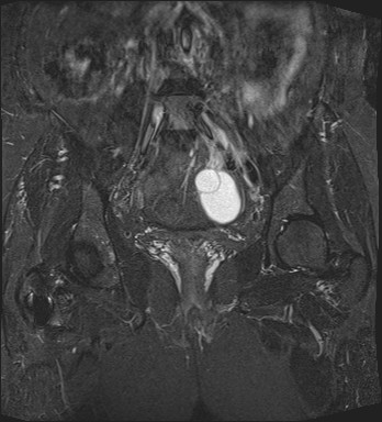 File:Adnexal multilocular cyst (O-RADS US 3- O-RADS MRI 3) (Radiopaedia 87426-103754 Coronal T2 fat sat 18).jpg