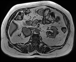 File:Adrenal cortical carcinoma (Radiopaedia 64017-72770 Axial T1 out-of-phase 35).jpg