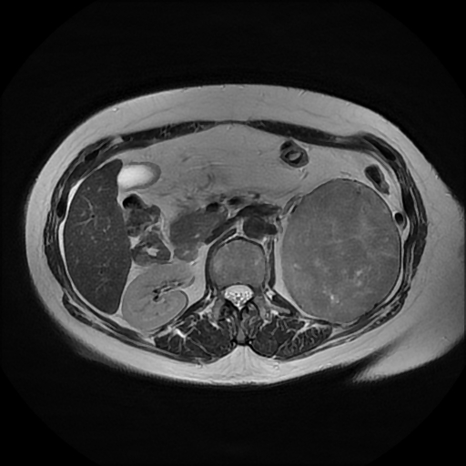 File:Adrenal cortical carcinoma (Radiopaedia 70906-81116 Axial T2 18).jpg