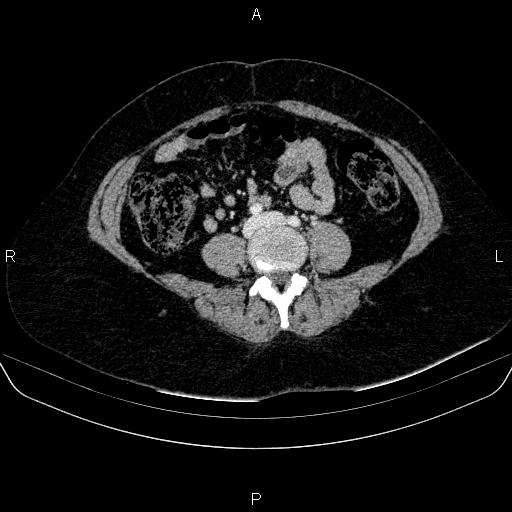 Adrenal cortical carcinoma (Radiopaedia 84882-100379 Axial C+ portal venous phase 58).jpg