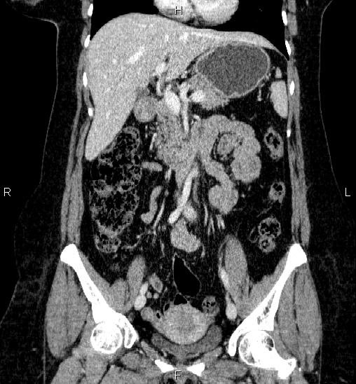Adrenal cortical carcinoma (Radiopaedia 84882-100379 Coronal C+ portal venous phase 28).jpg
