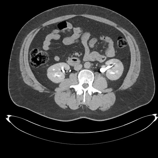 Adrenal cyst (Radiopaedia 45625-49778 AXIAL THICK 15 min 49).png