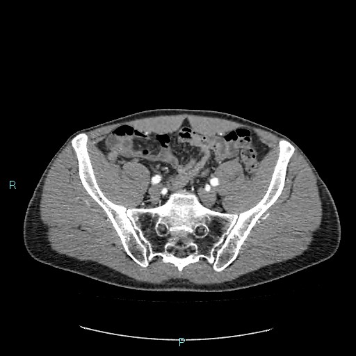 Adrenal cystic lymphangioma (Radiopaedia 83161-97534 Axial C+ arterial phase 75).jpg