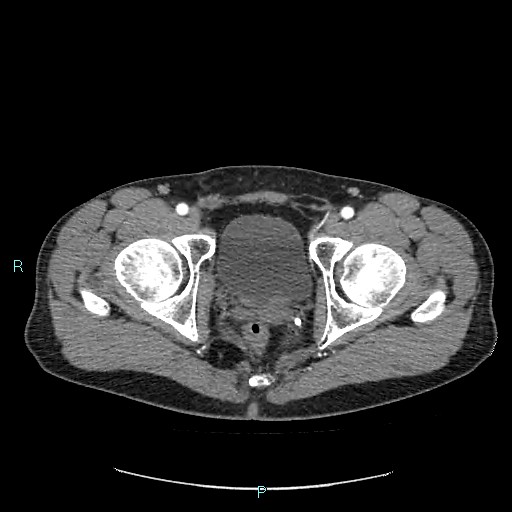 Adrenal cystic lymphangioma (Radiopaedia 83161-97534 Axial C+ arterial phase 95).jpg