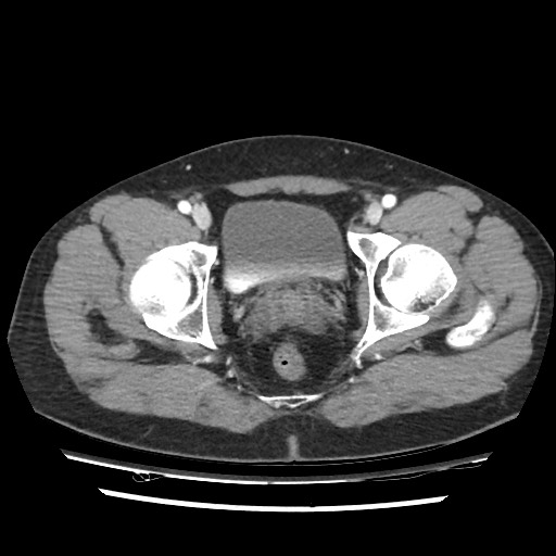 Adrenal gland trauma (Radiopaedia 81351-95078 Axial Dual bolus trauma C+ 116).jpg