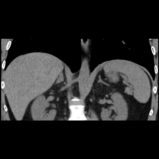 Adrenal gland trauma (Radiopaedia 81351-95079 Coronal non-contrast 54).jpg