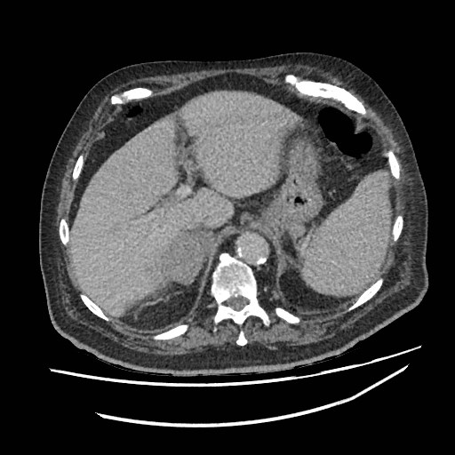 Adrenal lymphoma (Radiopaedia 84145-99415 Axial C+ portal venous phase 15).jpg
