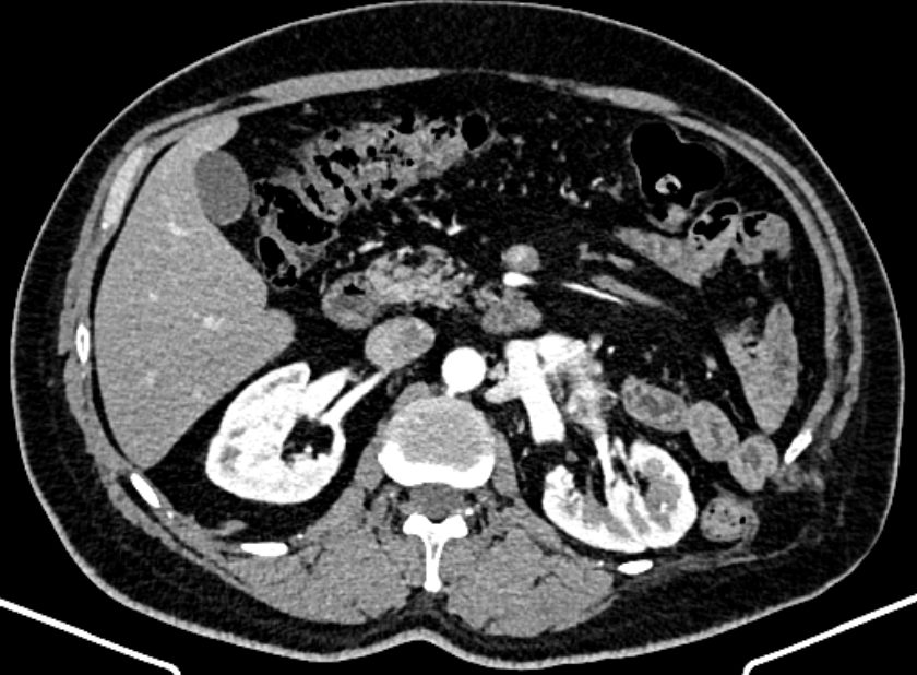 Adrenal metastases (Radiopaedia 73082-83791 Axial C+ arterial phase 70).jpg