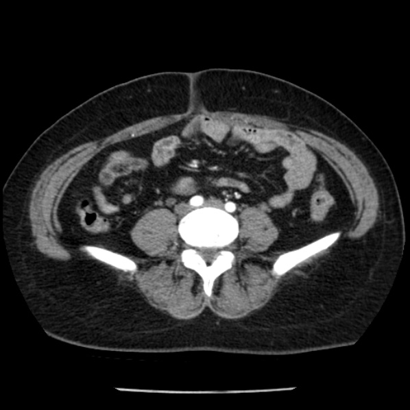 Adrenal myelolipoma (Radiopaedia 43401-46759 Axial C+ arterial phase 67).jpg