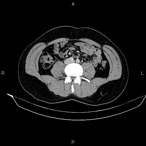 Adrenal myelolipoma (Radiopaedia 87794-104246 Axial renal cortical phase 63).jpg