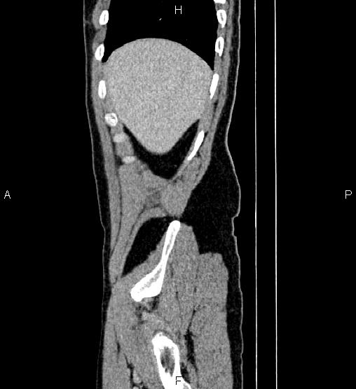 Adrenal myelolipoma (Radiopaedia 87794-104246 Sagittal renal cortical phase 10).jpg