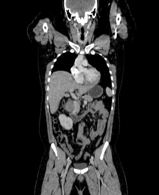 Adrenocortical carcinoma (Radiopaedia 80134-93438 Coronal C+ portal venous phase 69).jpg