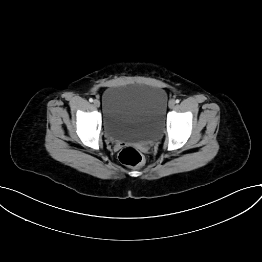 Adrenocortical carcinoma (Radiopaedia 87281-103569 Axial C+ portal venous phase 80).jpg