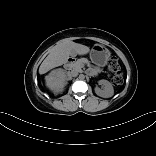 Adrenocortical carcinoma (Radiopaedia 87281-103569 Axial non-contrast 36).jpg