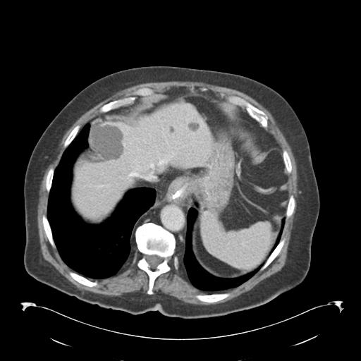 Adult ileal intussusception with secondary obstruction (Radiopaedia 30395-31051 Axial C+ portal venous phase 9).jpg