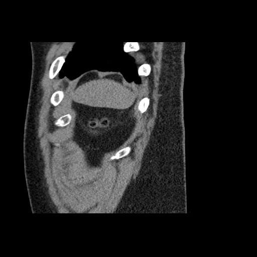 Adult polycystic kidney disease (Radiopaedia 59075-66368 Sagittal non-contrast 88).jpg