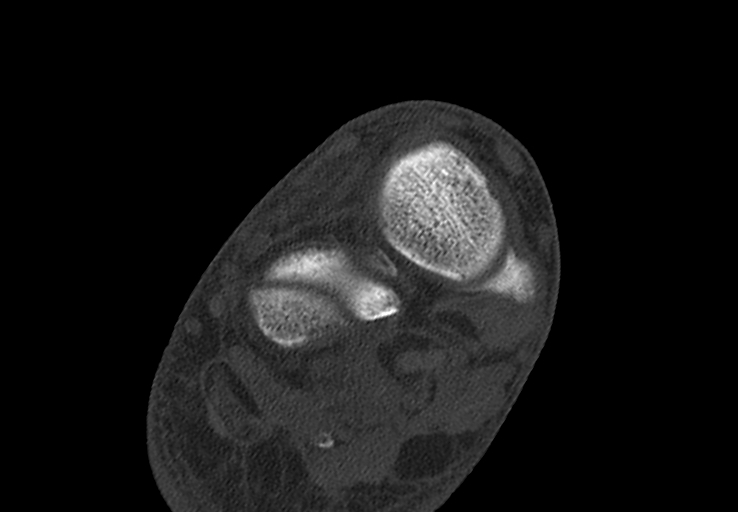Advanced osteomyelitis due to open metatarsal fracture (Radiopaedia 83891-99095 Axial bone window 16).jpg
