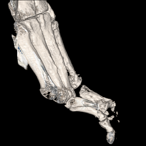 File:Advanced osteomyelitis due to open metatarsal fracture (Radiopaedia 83891-99095 VRT 21).jpg