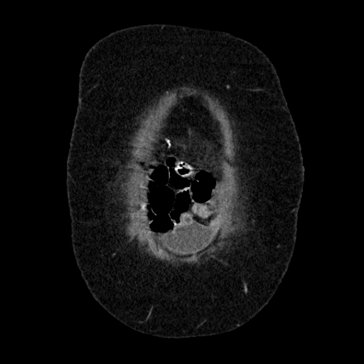File:Afferent loop syndrome - secondary to incarcerated trocar site hernia (Radiopaedia 82959-97305 Coronal C+ portal venous phase 26).jpg