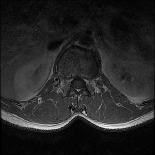 File:Aggressive vertebral hemangioma with pathological fracture (Radiopaedia 69528-79411 Axial T1 C+ 14).jpg