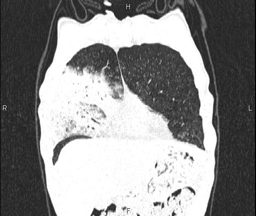 Air bronchogram in pneumonia (Radiopaedia 85719-101512 Coronal lung window 10).jpg