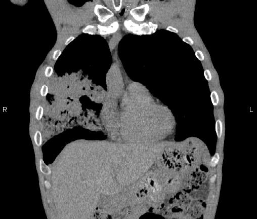 Air bronchogram in pneumonia (Radiopaedia 85719-101512 Coronal non-contrast 15).jpg