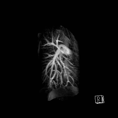 File:Alagille syndrome with pulmonary hypertension (Radiopaedia 49384-54502 Sagittal MRA 1).jpg