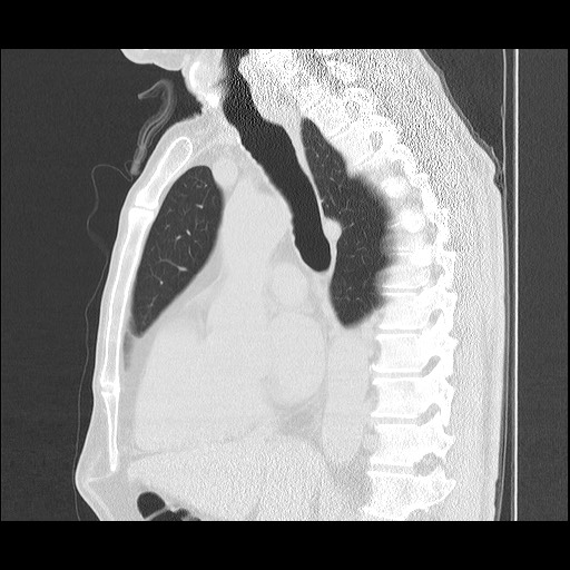 Allergic bronchopulmonary aspergillosis (ABPA) (Radiopaedia 60594-68313 Sagittal lung window 31).jpg