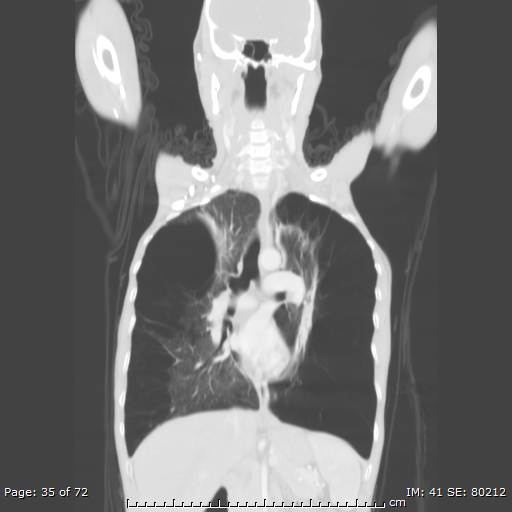 Alpha-1-antitrypsin deficiency (Radiopaedia 50561-55987 Coronal lung window 33).jpg