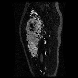 Alveolar soft part sarcoma (Radiopaedia 64501-73678 D 80).jpg