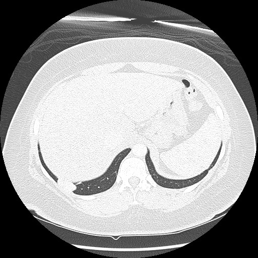 Alveolar soft part sarcoma - right leg (Radiopaedia 59432-67091 Axial lung window 103).jpg