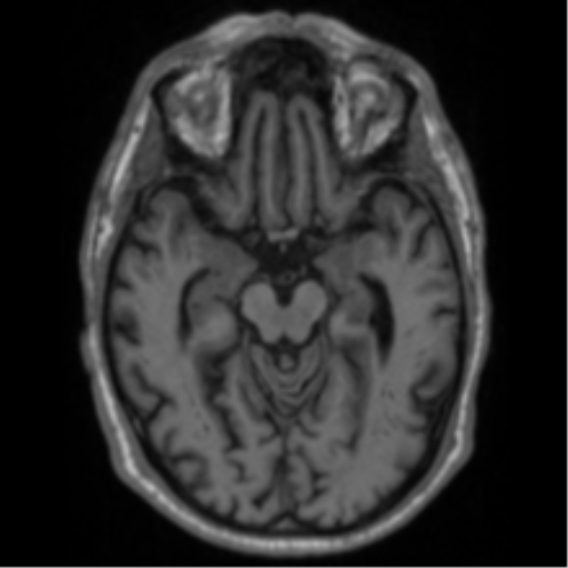 Alzheimer's disease- with Gerstmann syndrome and dressing apraxia (Radiopaedia 54882-61150 Axial T1 29).png