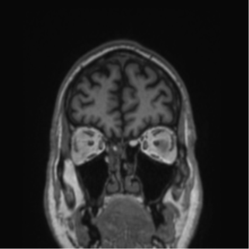 File:Alzheimer's disease- with Gerstmann syndrome and dressing apraxia (Radiopaedia 54882-61150 Coronal T1 77).png