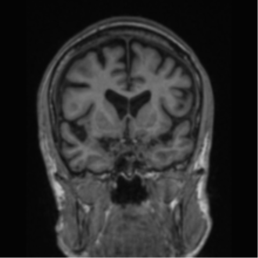File:Alzheimer's disease- with apraxia (Radiopaedia 54763-61011 Coronal T1 61).png