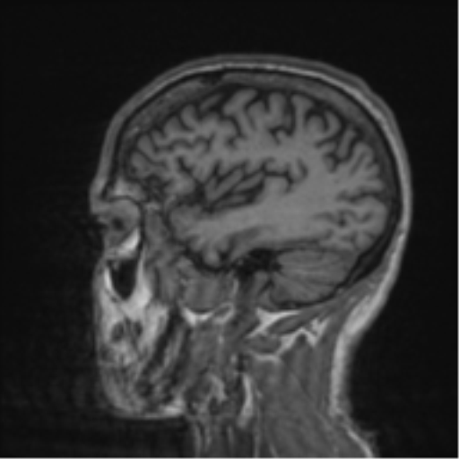 File:Alzheimer's disease- with apraxia (Radiopaedia 54763-61011 Sagittal T1 16).png