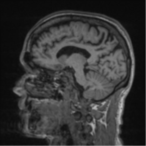 Alzheimer's disease- with apraxia (Radiopaedia 54763-61011 Sagittal T1 41).png