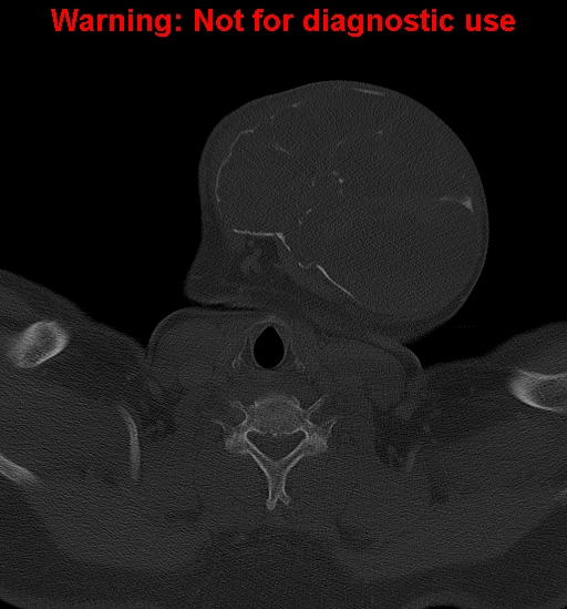 Ameloblastoma (Radiopaedia 33126-34164 Axial bone window 32).jpg