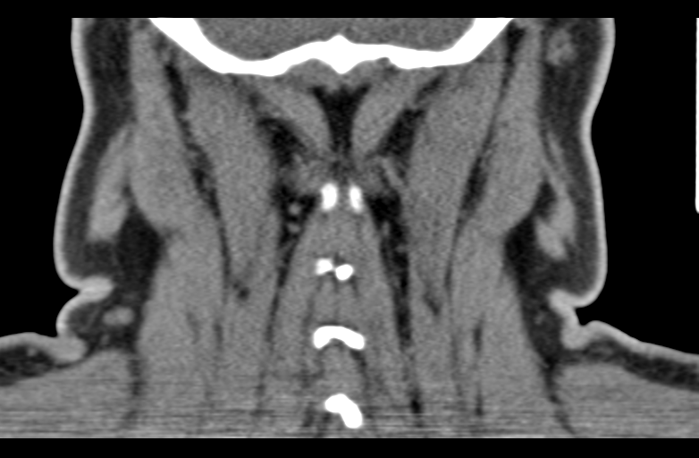 Ameloblastoma (Radiopaedia 33677-34806 Coronal non-contrast 61).png