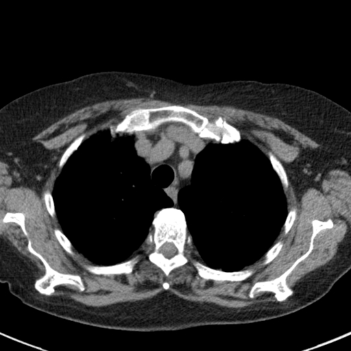 File:Amiodarone-induced pulmonary fibrosis (Radiopaedia 82355-96460 Axial non-contrast 17).jpg