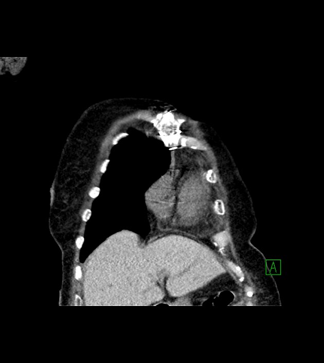 Amiodarone deposition in the liver (Radiopaedia 77587-89780 Coronal non-contrast 18).jpg