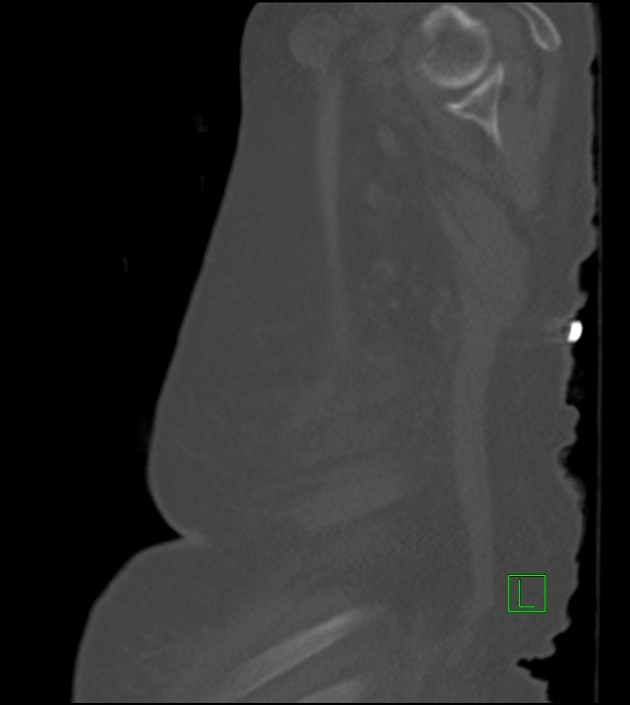 Amiodarone deposition in the liver (Radiopaedia 77587-89780 Sagittal bone window 12).jpg