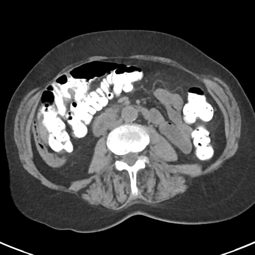 File:Ampullary adenocarcinoma (Radiopaedia 34013-35237 Axial non-contrast 31).png