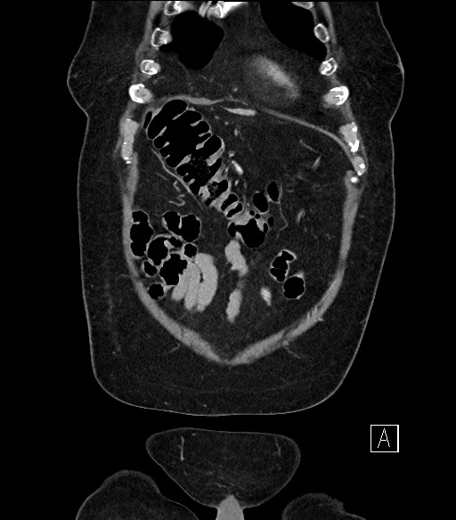Ampullary adenocarcinoma (Radiopaedia 59373-66734 D 4).jpg