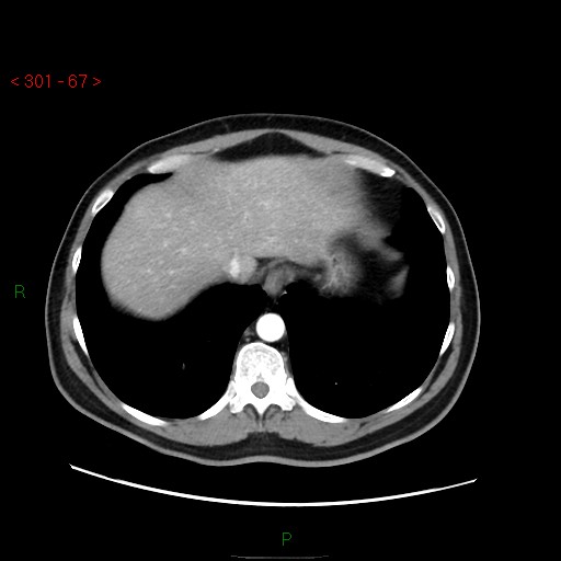 Ampullary carcinoma (Radiopaedia 56396-63056 B 13).jpg