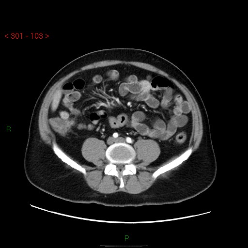 Ampullary carcinoma (Radiopaedia 56396-63056 B 49).jpg