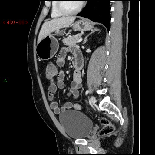 Ampullary carcinoma (Radiopaedia 56396-63056 D 65).jpg