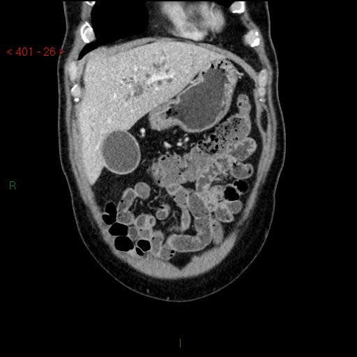 Ampullary carcinoma (Radiopaedia 56396-63056 E 25).jpg