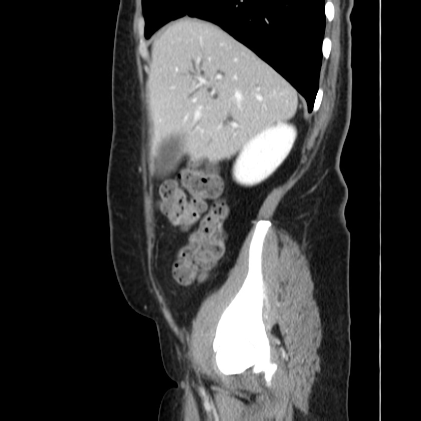 Ampullary tumor (Radiopaedia 22787-22816 D 14).jpg