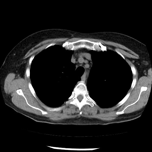 Amyloidosis - bronchial and diffuse nodular pulmonary involvement (Radiopaedia 60156-67744 Axial non-contrast 16).jpg